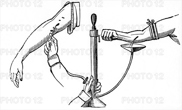 Person-to-person blood transfusion