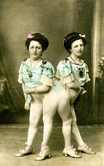 The Siamese twins Josefa and Rosa Blazek