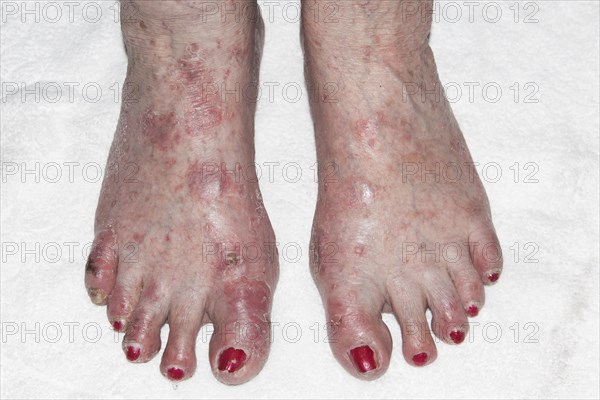 Patient with Atopic dermatitis or endogenous eczema