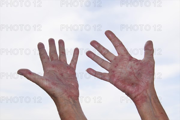 Patient with Atopic dermatitis or endogenous eczema