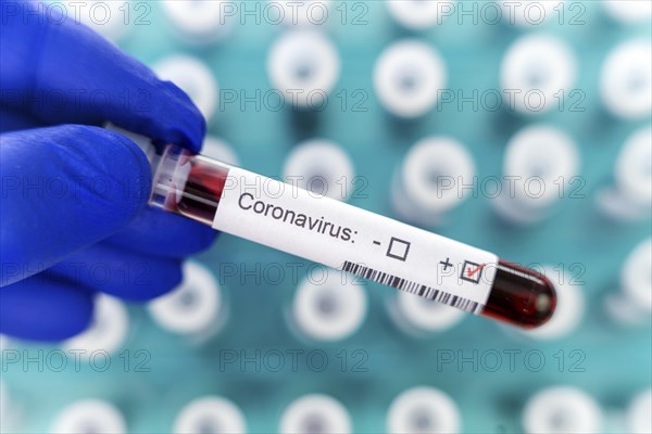 Laboratory physician holds a blood test tube with positive test result