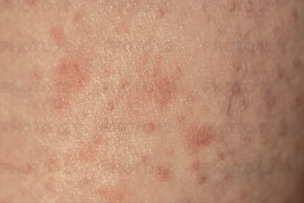 Skin with reddened spots