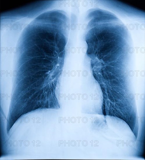 X-Ray Image Of Human Healthy Chest