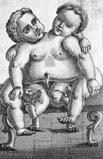 Siamese twins born in Palermo in 1755