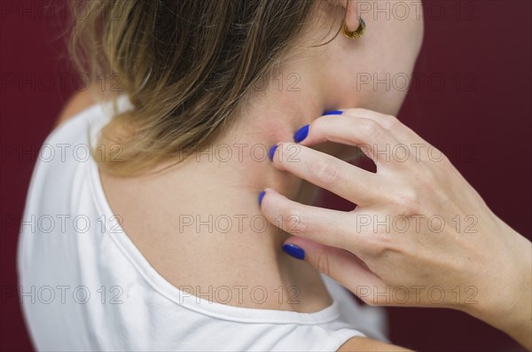 Great concept of allergy and skin diseases, young woman scratching herself