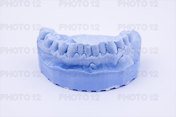 Denture impression of an upper jaw for dentures, dentist, dental impression