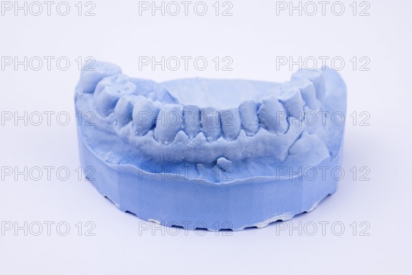 Denture impression of an upper jaw for dentures, dentist, dental impression