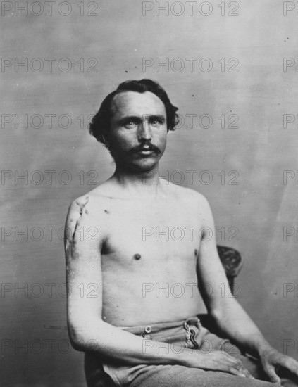 War-wounded Private Adolph Zirsse, Successful intermediate excision of the head and two and a half centimetres of the shaft of the right humerus, from the Photographic Catalogue of the Department of Surgery, 1880, Photo by William Bell, Historic, digitally restored reproduction from an original of the period