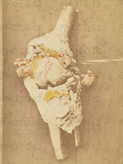 Arthropathie du genou, chez une ataxique (lésions anatomiques), 1871. Creator: Arthur de Montmeja.