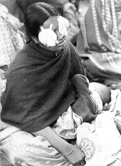 Woman eyes bandaged, Union Carbide gas leak tragedy, Bhopal, Madhya Pradesh, India, Asia, Bhopal disaster, Bhopal gas tragedy, 1984, old vintage 1900s picture