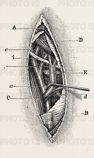 ligature, medical equipment, surgical instrument, history of medicine