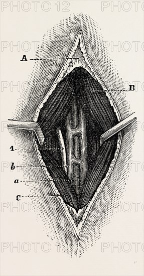 tractor, the outer border of the ligature, medical equipment, surgical instrument, history of medicine