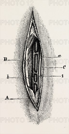 ligature, medical equipment, surgical instrument, history of medicine