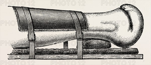 supporting splint adjusted to the leg, medical equipment, surgical instrument, history of medicine