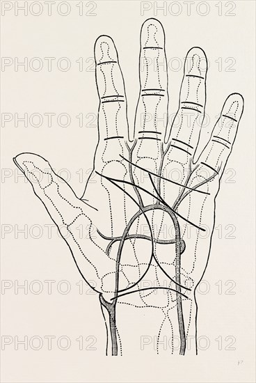 surface markings on the palm of ffile hand, the thick black lines represent the chief creases of the skin, medical equipment, surgical instrument, history of medicine