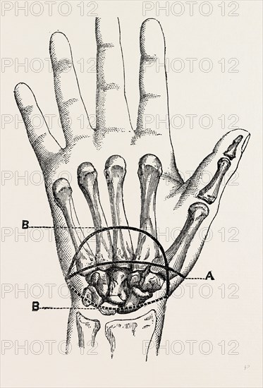 the first incision, palmar incision in the circular, medical equipment, surgical instrument, history of medicine