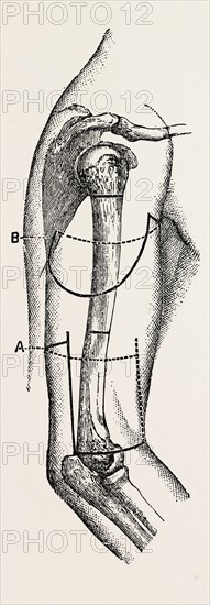 amputation, medical equipment, surgical instrument, history of medicine