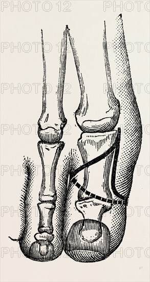 disarticulation, medical equipment, surgical instrument, history of medicine