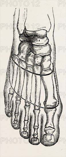 lisfranc's amputation, medical equipment, surgical instrument, history of medicine