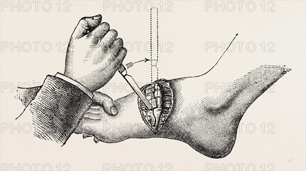 the coup de maitre in lisfrancis amputation, second step, medical equipment, surgical instrument, history of medicine