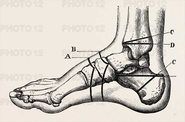 farabeuf's subastragaloid amputation, medical equipment, surgical instrument, history of medicine