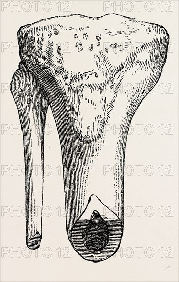 method of sawing, medical equipment, surgical instrument, history of medicine