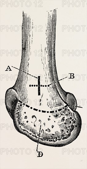 macewen, medical equipment, surgical instrument, history of medicine