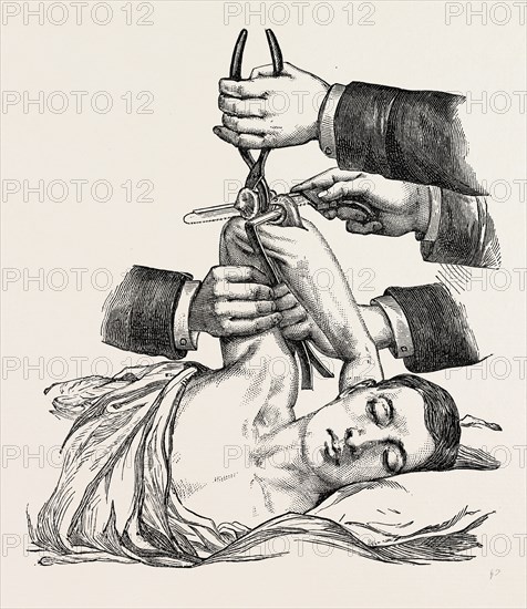 excision of the elbow, sawing of the humerus, medical equipment, surgical instrument, history of medicine