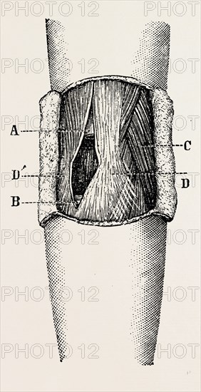 right elbow after excision, medical equipment, surgical instrument, history of medicine