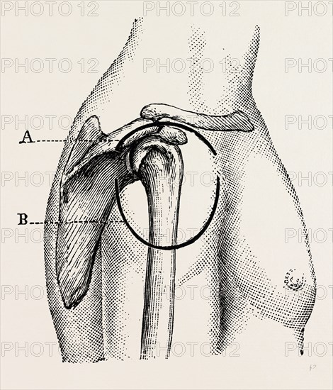 excision of the shoulder, medical equipment, surgical instrument, history of medicine