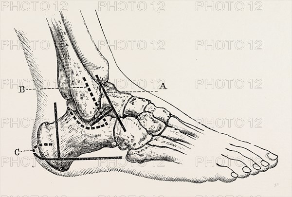 excision of astragalus, outer incision, medical equipment, surgical instrument, history of medicine