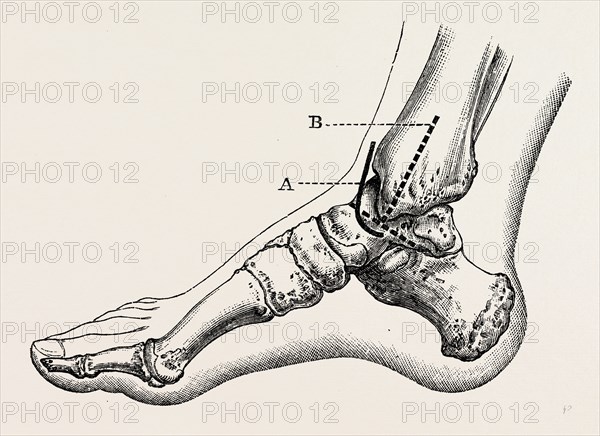 excision of astragalus, inner incision, medical equipment, surgical instrument, history of medicine