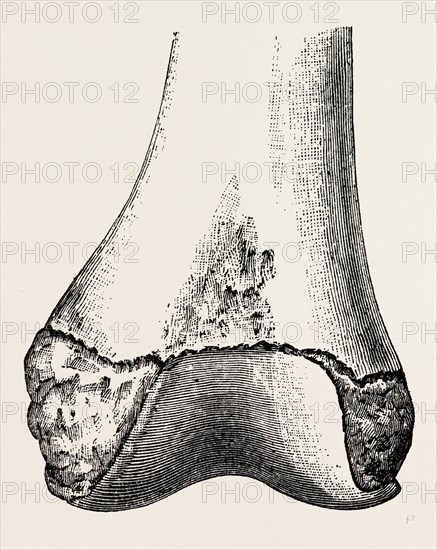 epiphyses of the femur, medical equipment, surgical instrument, history of medicine