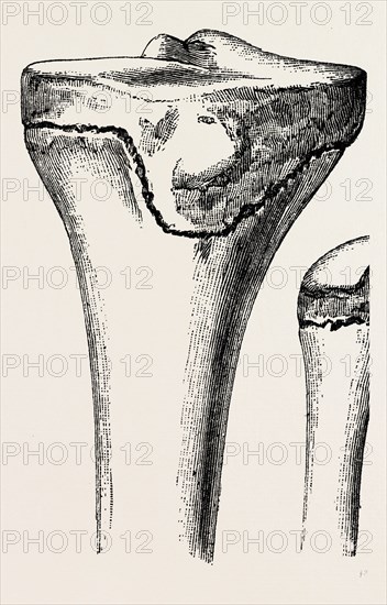 epiphyses of the femur, medical equipment, surgical instrument, history of medicine