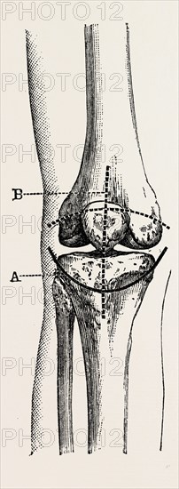 excision of the operation the limb, medical equipment, surgical instrument, history of medicine