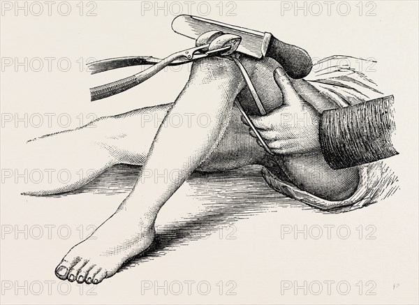 excision of the knee, the sawing of the lower end, medical equipment, surgical instrument, history of medicine