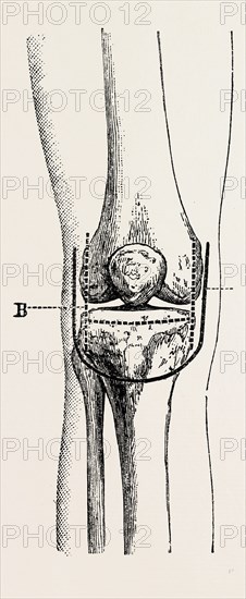 excision, medical equipment, surgical instrument, history of medicine