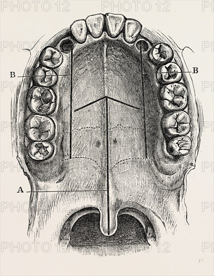 nelaton's operation for nasal polypus, medical equipment, surgical instrument, history of medicine