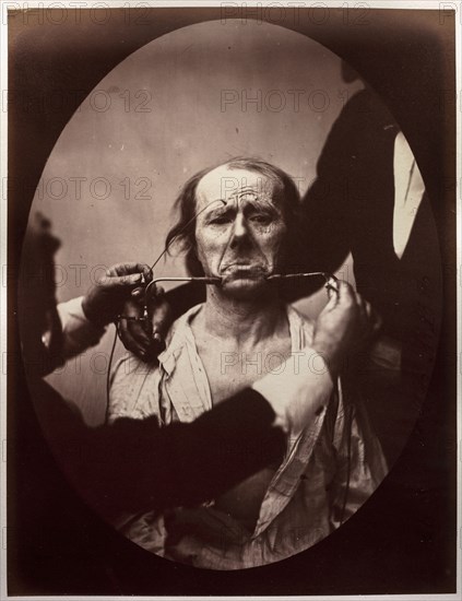 Mécanisme de la physionomie humaine: Figure 45: Contraction électrique forte des triangulaires des lèvres et des sourciliers: douleur et déspoir, c. 1856. Guillaume-Benjamin-Amand Duchenne (de Boulogne) (French, 1806-1875), Adrien Tournachon (French, 1825-1903). Albumen print from glass plate negative (printed 1862); image: 23.5 x 17.9 cm (9 1/4 x 7 1/16 in.); oval opening: 16.2 x 11.9 cm (6 3/8 x 4 11/16 in.); mounted: 41.2 x 27.4 cm (16 1/4 x 10 13/16 in.)