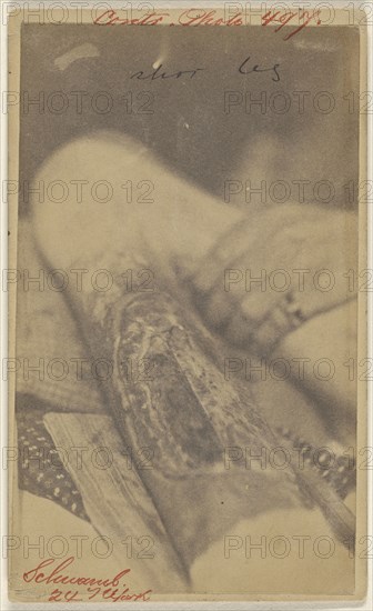 Wounded leg of R. Schwamb, Civil War victim; Attributed to Edward J. Ward, American, active 1860s - 1870s, 1877; Albumen silver