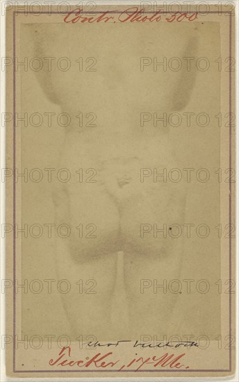 Jno. E. Tucker, shot in the buttocks, Civil War victim; American; 1865 - 1870; Albumen silver print