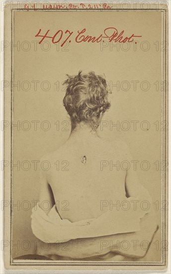 G.L. Mason, Pv. F. 211 Pa. Civil War victim; American; about 1865; Albumen silver print