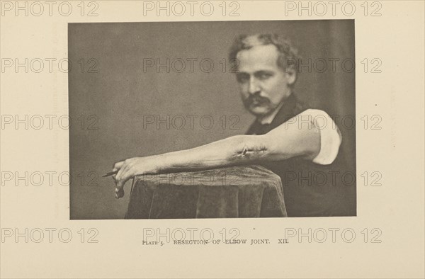 Resection of Elbow Joint; Charles B. Brigham, American, 1845 - 1903, Cambridge, Massachusetts, United States; 1876; Heliotype