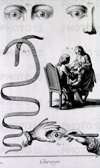 Eye maladies ca. 1700s