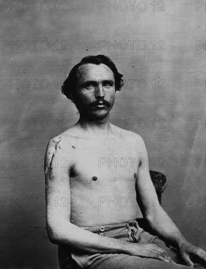 War-wounded Private Adolph Zirsse, Successful intermediate excision of the head and two and a half centimetres of the shaft of the right humerus, from the Photographic Catalogue of the Department of Surgery, 1880, Photo by William Bell, Historic, digitally restored reproduction from an original of the period.