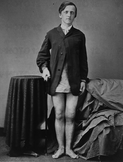 War-wounded Private G. W. Warrington, recovering without amputation after gunshot fracture of the right kneecap, from the Surgical Department photo catalogue, 1880, photo by William Bell, Historic, digitally restored reproduction from an original of the period.