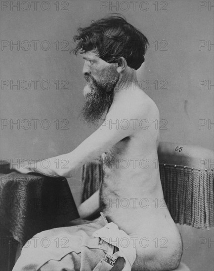 War-wounded Private John Bar, recovering from a penetrating abdominal wound with fracture of the left os innominatum, from the Surgical Department Photographic Catalogue, 1880, photograph by William Bell, Historic, digitally restored reproduction from an original of the period.