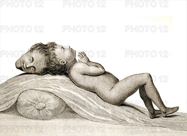 child with two heads joined at the apex, Siamese twins, Double malformation, a maldevelopment in which identical twins remain physically joined to each other during the course of their intrauterine development and after birth, Historical, digitally restored reproduction from an original of the time.